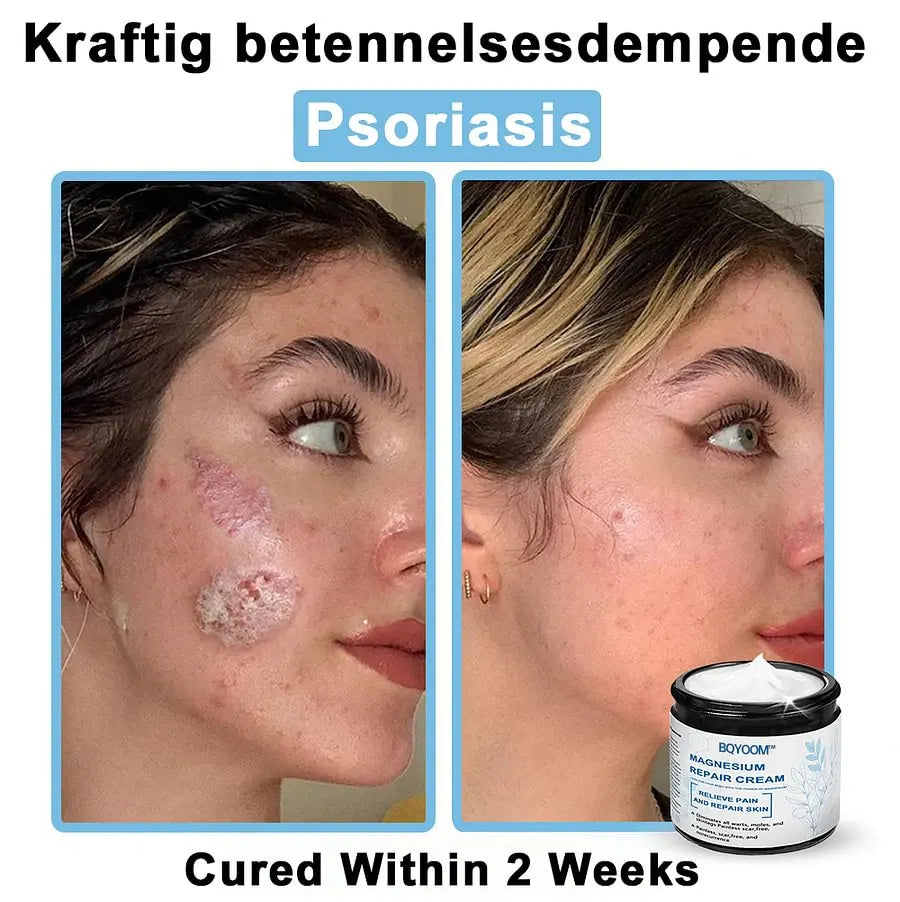 BQYOOM™ Magnesium skin repair cream👨‍⚕️NHS Approved (Psoriasis and Eczema Relief, Skin Repair, Even Tone, Acne and Dark Spot Treatment, Wart and Mole Removal)