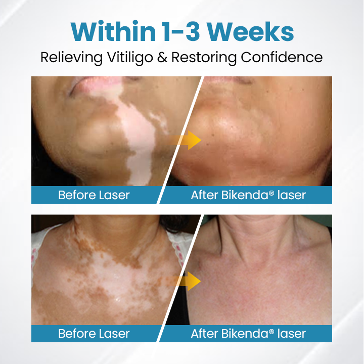 Biikenda® DermaBeam Vitiligo Therapy Device⏳Limited-time 49% off⏰💥