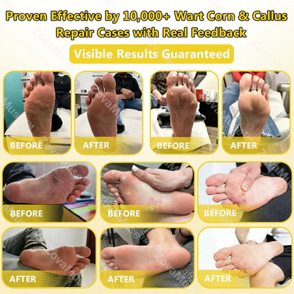 Bee Venom Corn & Callus Remover Cream
