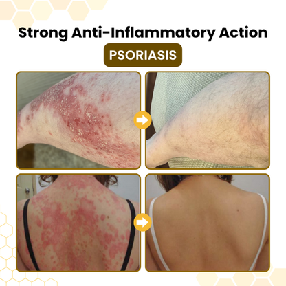 💥Timilk® PsoriaSoothe Bee Venom Skin-Restoration Cream⏳Limited-time 49% off⏰💥