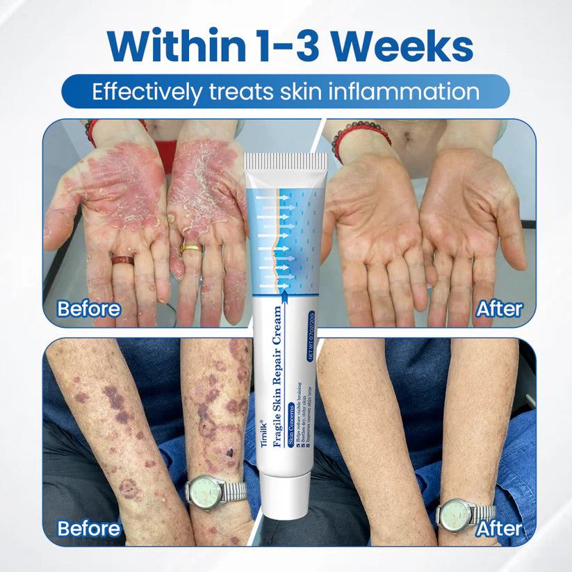 Timilk® Fragile Skin Repair Cream🎂