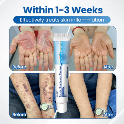Timilk® Fragile Skin Repair Cream🎂
