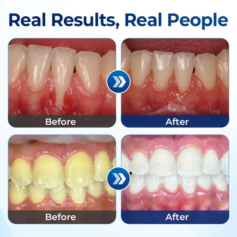 Mresio® RegenDent Advanced Tooth & Gum Renewal Device