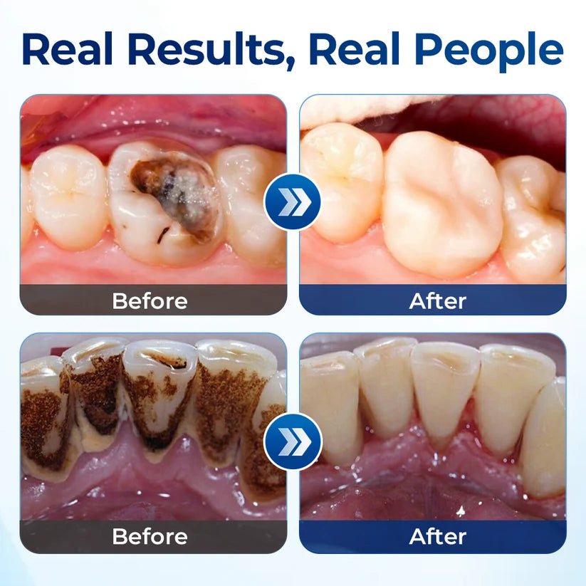 Mresio® RegenDent Advanced Tooth & Gum Renewal Device