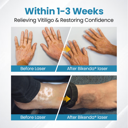 Biikenda® DermaBeam Vitiligo Therapy Device⏳Limited-time 49% off⏰💥