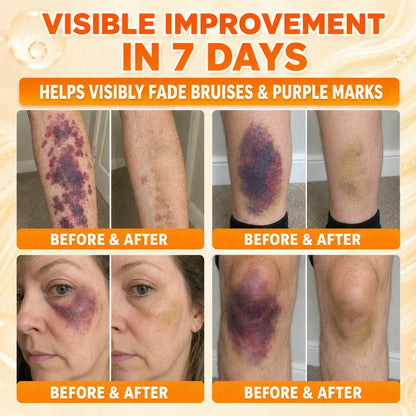 🔥𝐇𝐞𝐚𝐥𝐫𝐢𝐳𝐞® Premium Vitamin K Bruise Repair Cream