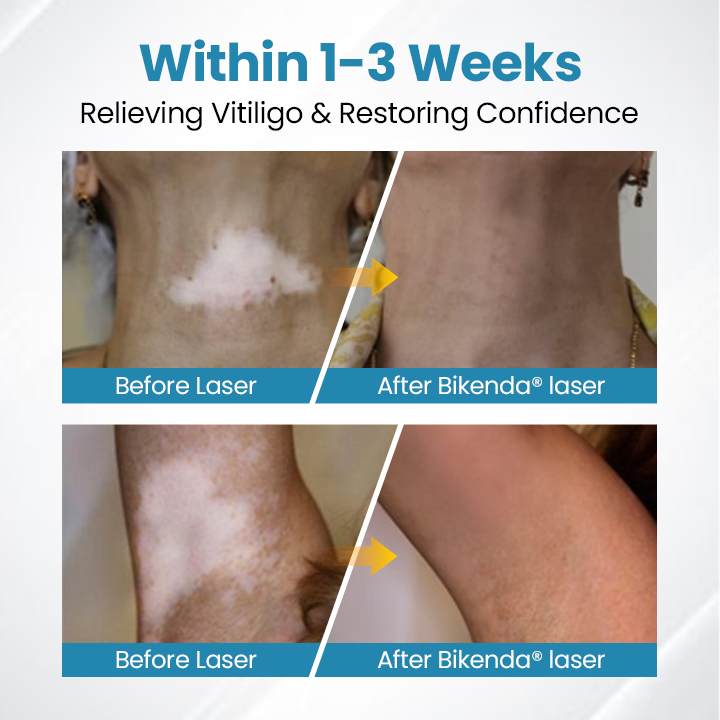Biikenda® DermaBeam Vitiligo Therapy Device⏳Limited-time 49% off⏰💥