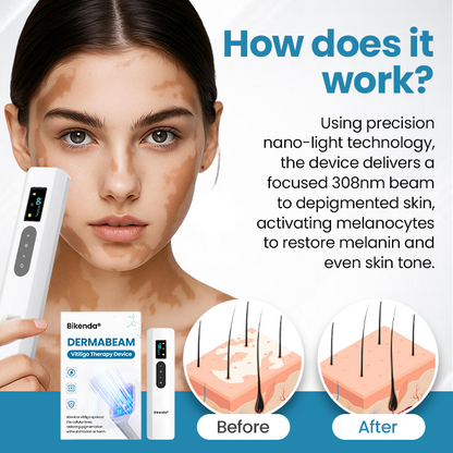 Biikenda® DermaBeam Vitiligo Therapy Device⏳Limited-time 49% off⏰💥