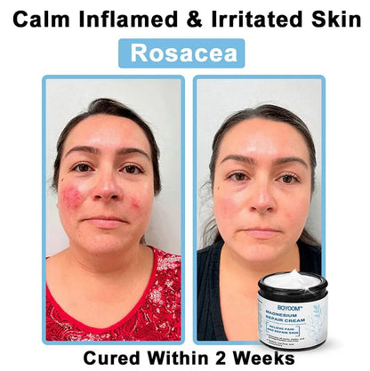 BQYOOM™ Magnesium skin repair cream👨‍⚕️NHS Approved (Psoriasis and Eczema Relief, Skin Repair, Even Tone, Acne and Dark Spot Treatment, Wart and Mole Removal)