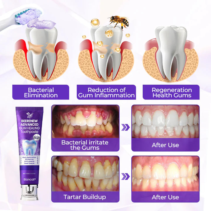 BeeRenew Advanced Gum Healing Toothpaste🎉SPECIAL OFFER: 60% OFF This Today Only!🔥