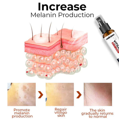 South Moon™ Vitiligo Relief Spray